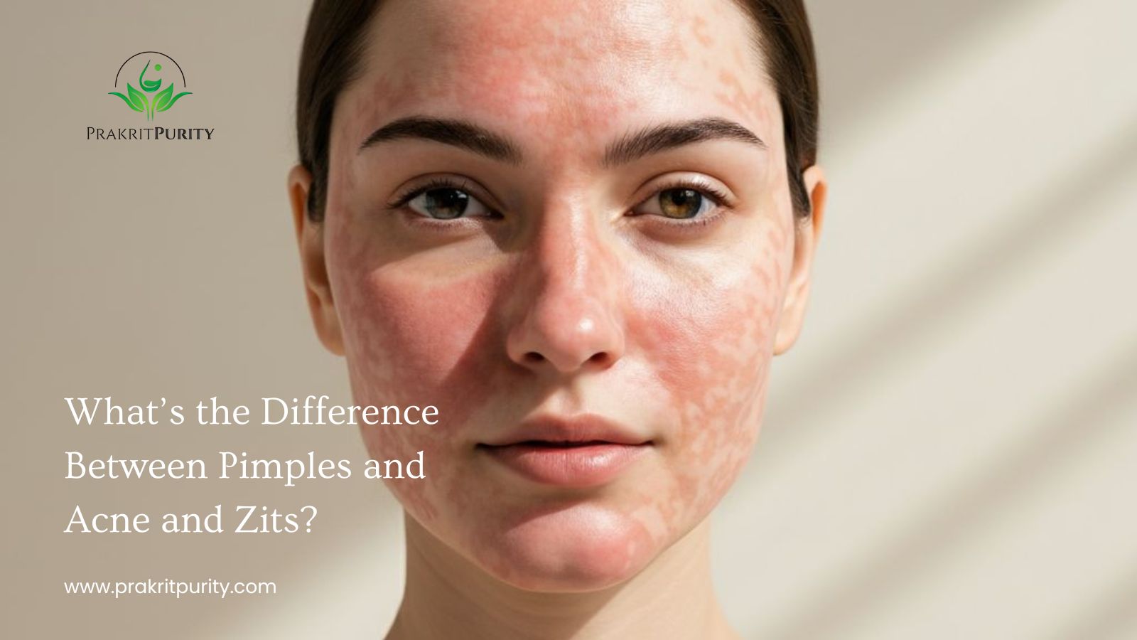 What’s the Difference Between Pimples and Acne and Zits?