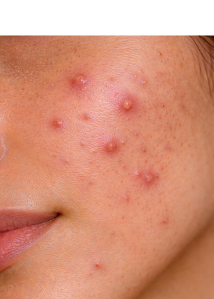 Skin Feels Clogged & Breaking Out